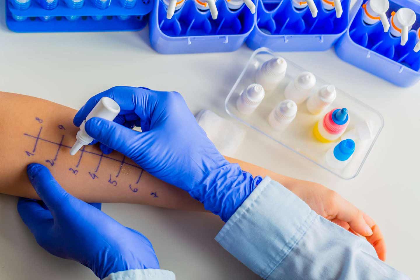 Prick test - kožni test na alergiju