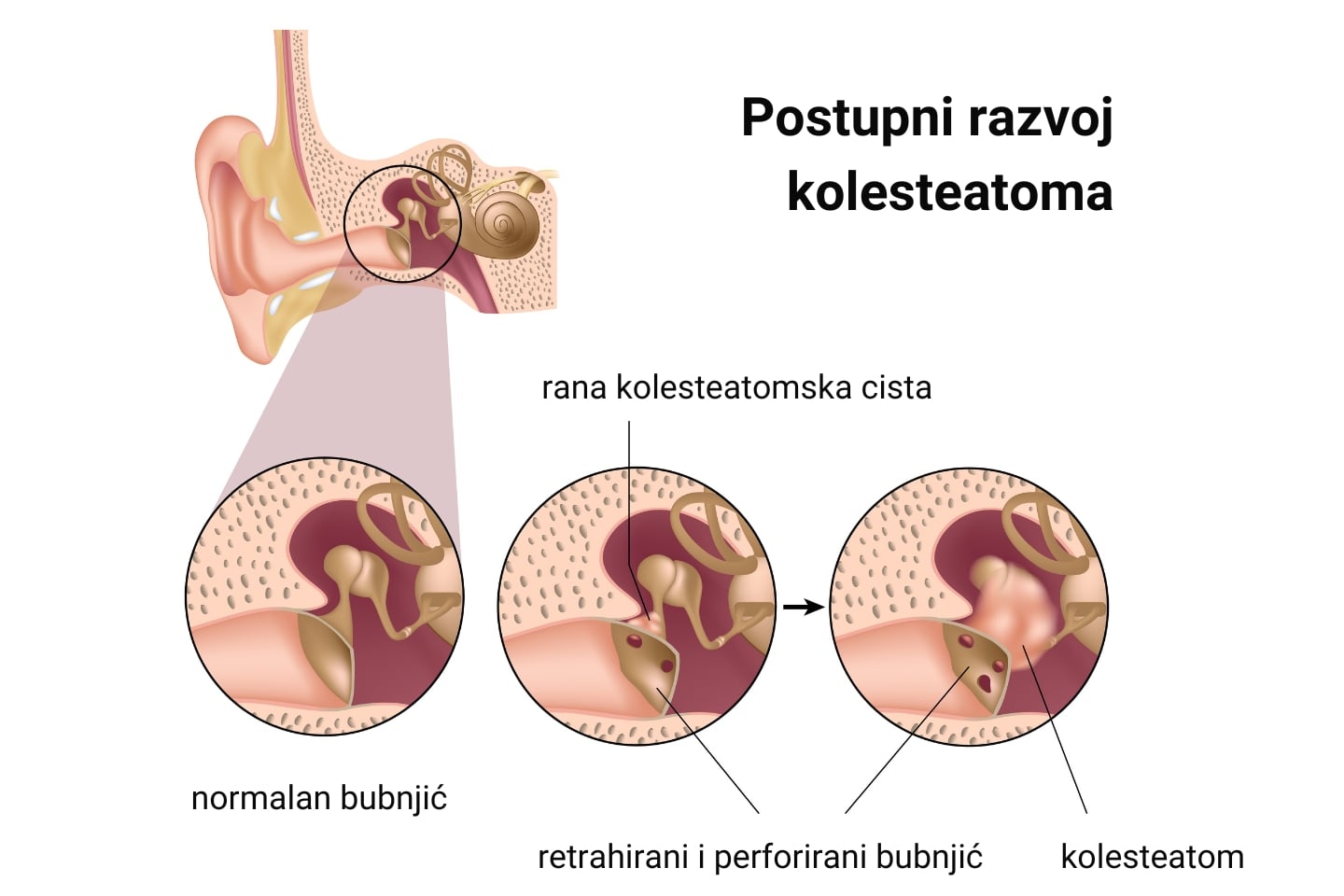 Shematski prikaz postupnog razvoja kolesteatoma