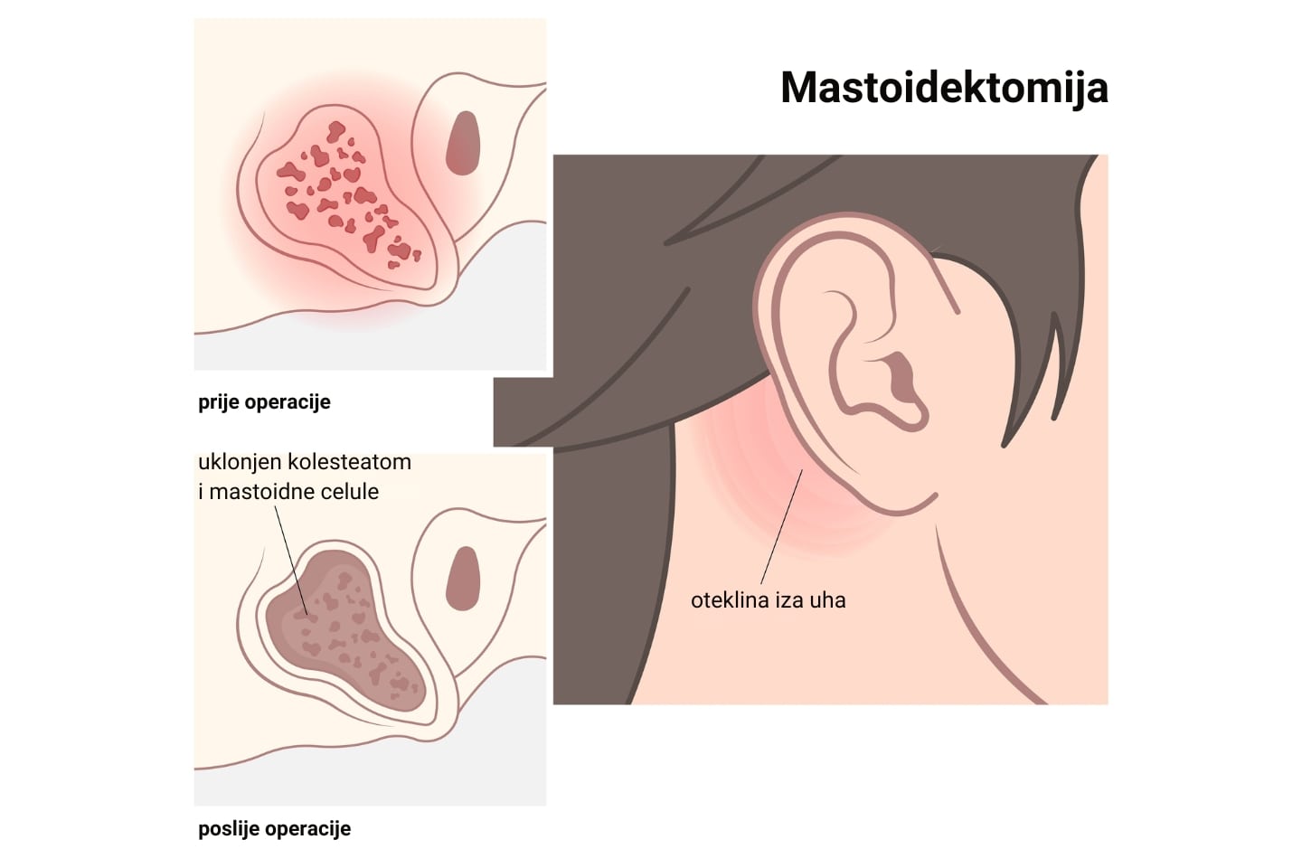 Shematski prikaz mastoidektomije u slučaju kolesteatoma