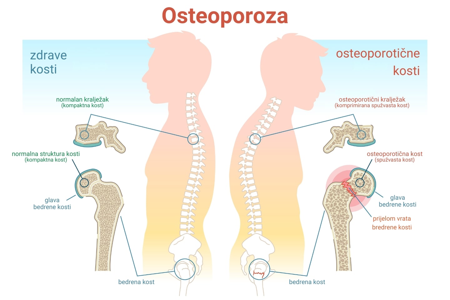 Ilustracija usporedbe zdrave i osteoporotične kosti